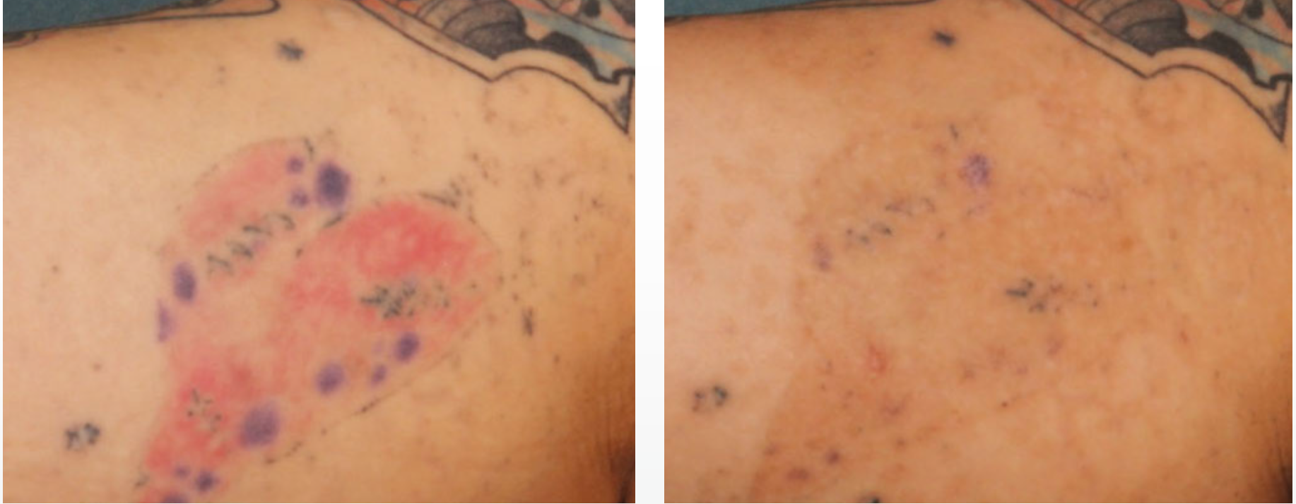 Laser Tattoo Removal near me  The Norwich Face  Body Clinic